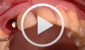 Immediate Function mit NobelPerfect™ Implantaten bei aggressiver Parodontitis