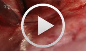 Distraktionsosteotomie Unterkiefer