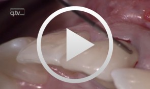 Soft Tissue Management in Immediate Implantation in Region 21