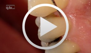 Regenerative Treatment on Tooth 14 und 24
