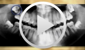 Operative Therapiekonzepte retinierter Oberkieferzähne