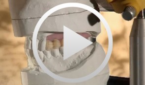 Sinus Floor Augmentation with Autogenous Chin Bone Grafts