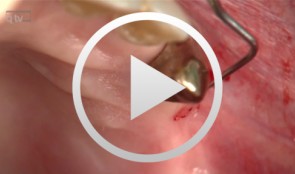 Prothetische Vorplanung und prothetisch geleitete minimalinvasive Implantation