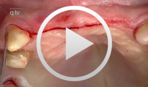 Preimplant Augmentation Procedures to Improve the Hard Tissue Situation in the Upper Anterior Region