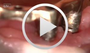 Implantatplastik Regio 34