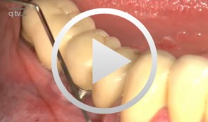Implantatplastik und freies Bindegewebstransplantat Regio 45