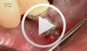 Implantatplastik und freies Schleimhauttransplantat Regio 42