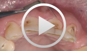 Veneer preparation in cases with wedge-shaped defects