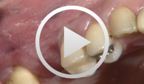 Augmentation regio 16 mit SonicWeld Rx System