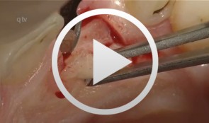 Immediate placement of a NobleActive implant in a patient with a pronounced hard-tissue and soft-tissue defect