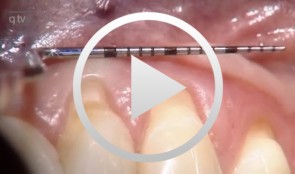 Recession coverage using human dermal tissue at site 22-26