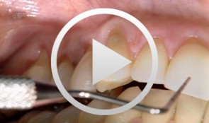 Recession coverage with coronally positioned flap