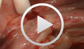 Implantation mit Facilitate 3D Planung, provisorischer Sofortversorgung und definitiver Versorgung mit Atlantis Abutments und Zirkonoxidbrücke
