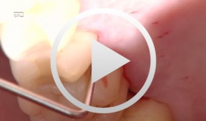 Treatment of a palatal class II furcation
