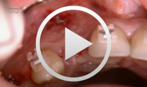Navigated implantation and connective-tissue graft