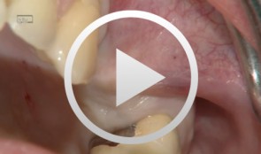 Implantatfreilegung in regio 24 und 25