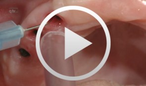 Implantatprothetische Arbeitsschritte am Patienten, Teil II