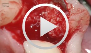 Anterior implant with concurrent bone augmentation (GBR)