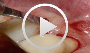 Flap surgery using a modified papilla preservation technique
