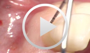 Interdisciplinary treatment of a patient with localized aggressive periodontitis
