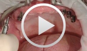 Clinical implant prosthodontics - Part III