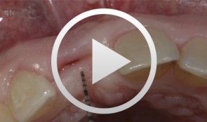 Bone augmentation in the anterior region in preparation for implants