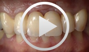 Implantatgetragener Zahnersatz mit Knochenaugmentation und Weichgewebetransplantation zur Papillenneubildung (Klinik und Labor)