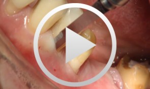 Periodontal Preserve Therapy (Examples)