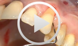 Covering a Recession with a Soft Tissue Transplant
