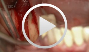 Sandwich osteotomy in the posterior mandible