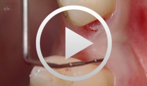 Computergeführte Implantatinsertion in regio 25