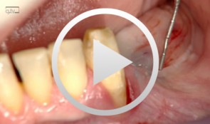 Insertion of three implants in the posterior mandible following bone augmentation using the compact-bone plate technique