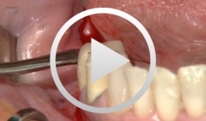 12 weeks after a sandwich osteotomy in the posterior mandible: implant insertion