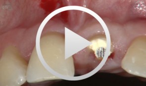 Immediate implant placement at site 21 with combination-graft closure