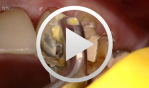 Von der Anamnese bis zum Implantat und prothetischer Versorgung: Der komplexe Fall (Live-OP)