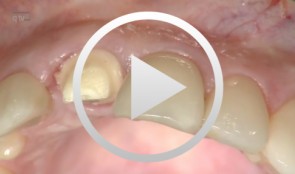 Immediate implant placement and restoration of tooth 21 with augmentation of the buccal wall with autologous bone