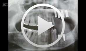 Vestibulumplastik mit Schleimhauttransplantat bei Implantatfreilegung nach Oberkieferrekonstruktion