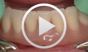 Fiberglass frameworks in removable prosthodontics