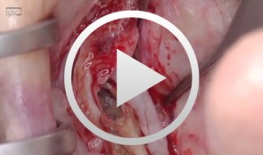 Live surgery Surgical treatment of bone necrosis