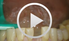 Implantation in der UK-Front mit gleichzeitiger Knochenaugmentation