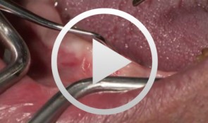3D planning and template-guided implant insertion in the edentulous jaw