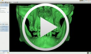 3D-Planung und schablonengeführte Implantation im teilbezahnten Kiefer