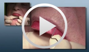 Implant-supported removable restorations in the edentulous jaw