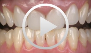 Immediate placement and all-ceramic restoration in the anterior maxilla - a customized interdisciplinary treatment approach - Clinical procedure