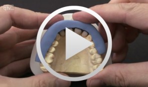 Immediate placement and all-ceramic restoration in the anterior maxilla - a customized interdisciplinary treatment approach - Laboratory work