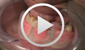 3D-Planung und schablonengeführte Implantation im zahnlosen Kiefer