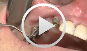 Free gingival graft to improve the biological soft-tissue situation around implants