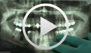 Rational implantation (individual implant in 20 min.)