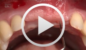 Peri-implant soft tissue management at the second stage surgery in the esthetic zone