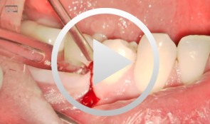 Microsurgical apical resection